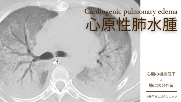 心原性肺水腫（CPE. Cardiogenic pulmonary edema） – 呼吸器疾患