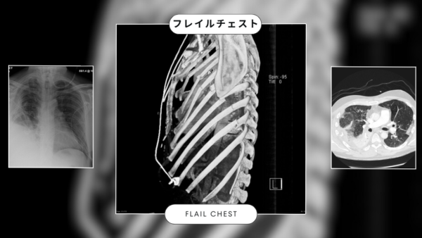 フレイルチェスト(動揺胸郭 flail chest) – 呼吸器疾患