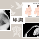 鳩胸(pectus carinatum) – 呼吸器疾患