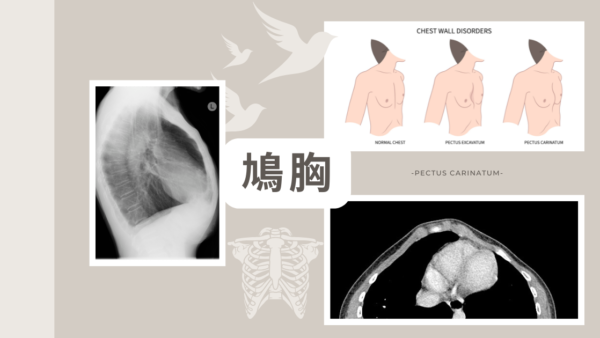 鳩胸(pectus carinatum) – 呼吸器疾患