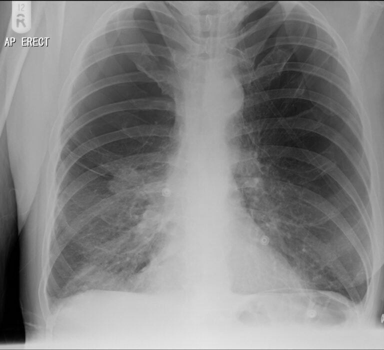 肺嚢胞症(Pulmonary cystic disease) – 呼吸器疾患 - 神戸きしだクリニック（神戸市中央区）