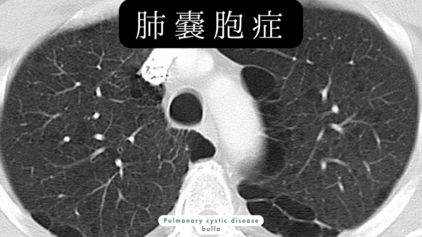 肺嚢胞症(Pulmonary cystic disease) – 呼吸器疾患