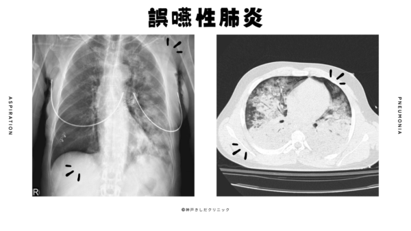 誤嚥性肺炎 (Aspiration pneumonia)