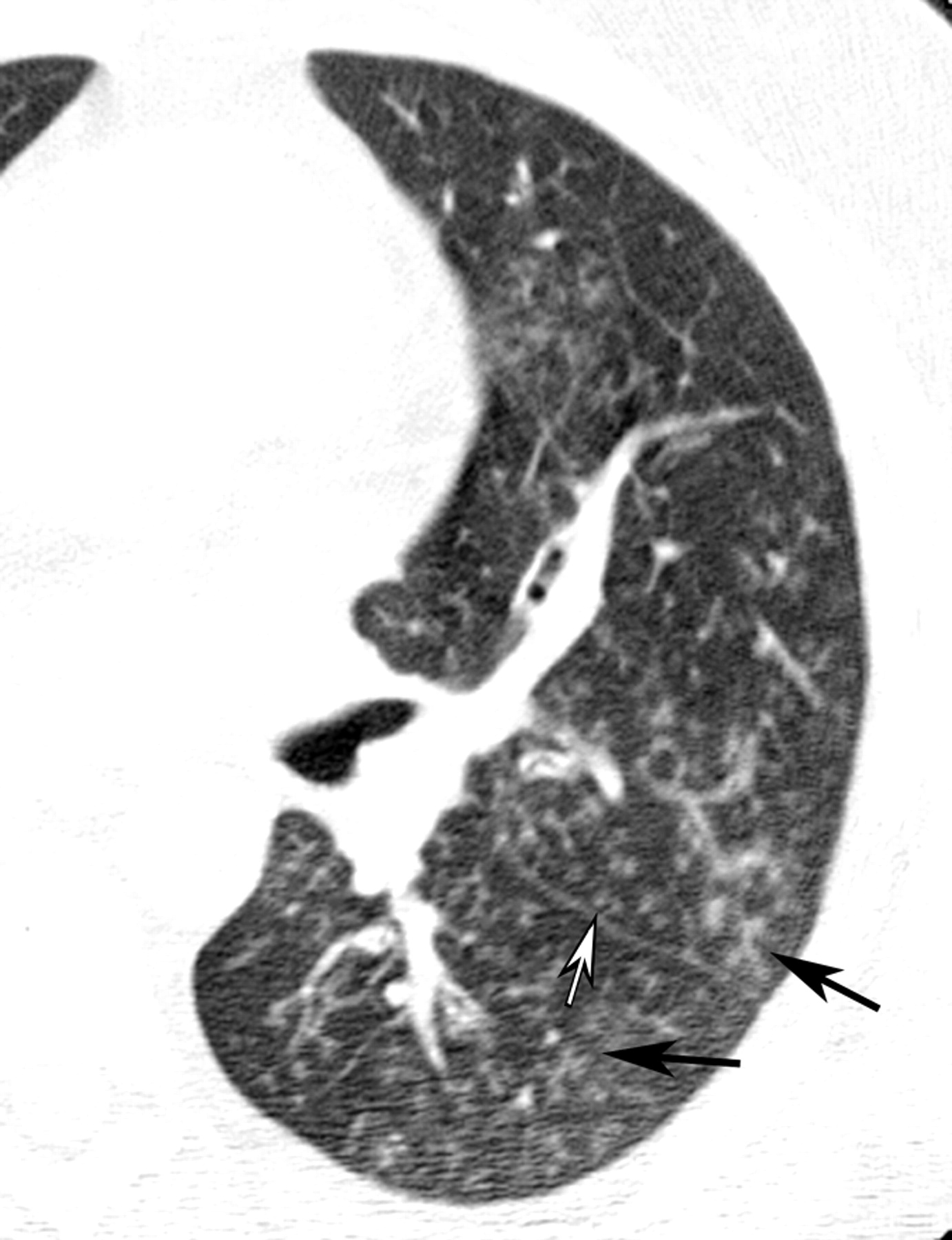 気管支炎 (Bronchitis) – 呼吸器疾患 - 神戸きしだクリニック（神戸市中央区）