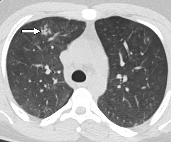 グッドパスチャー症候群はどのように治療されますか?