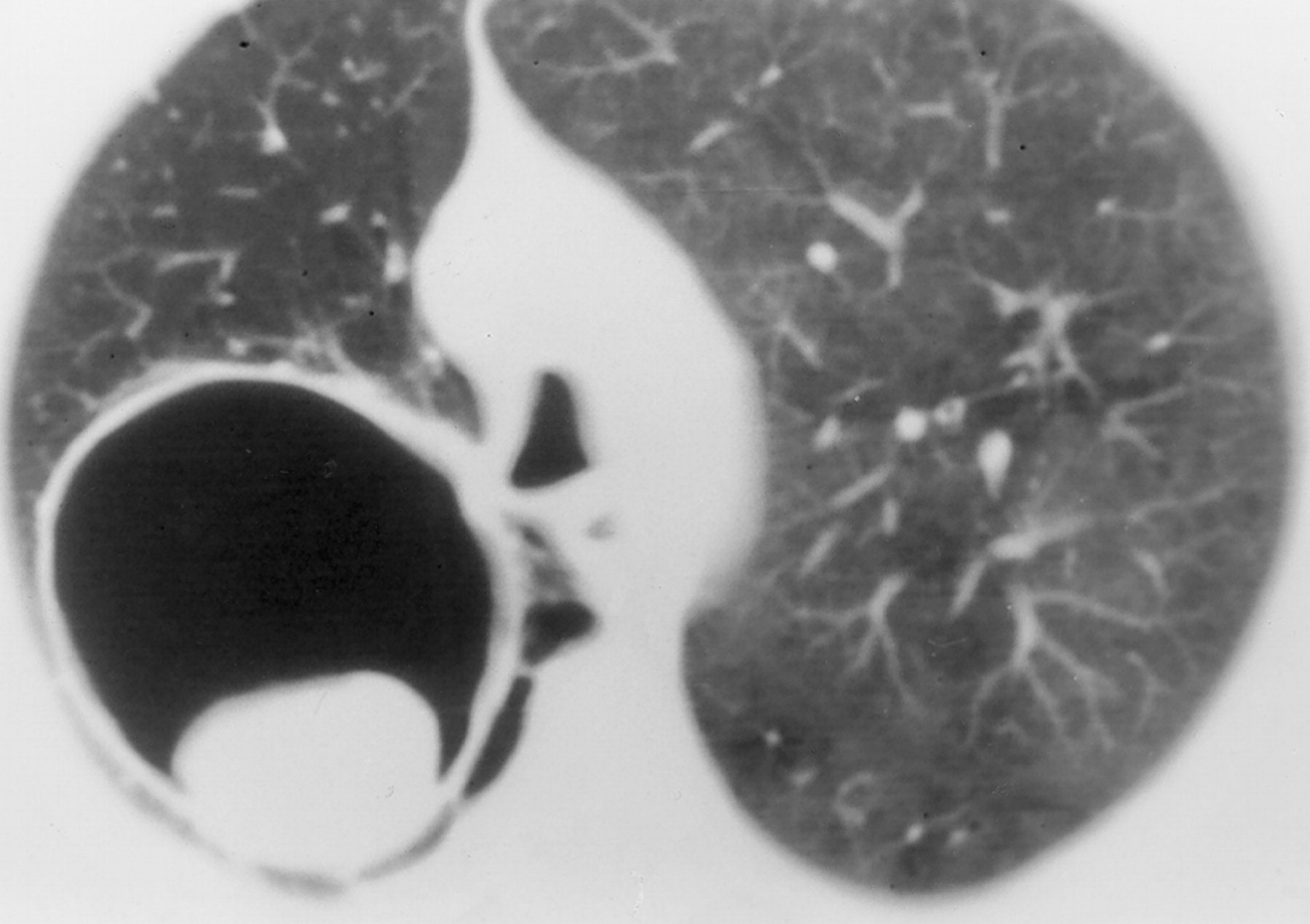 肺アスペルギルス症（Pulmonary aspergillosis） – 呼吸器疾患 - 神戸きしだクリニック（神戸市中央区）