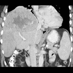 横隔膜麻痺(Diaphragmatic paralysis) – 呼吸器疾患 - 神戸きしだクリニック(神戸市中央区)