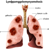 リンパ脈管筋腫症（LAM.Lymphangioleiomyomatosis） – 呼吸器疾患
