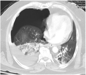 血胸(けっきょう / Hemothorax) – 呼吸器疾患 - 神戸きしだクリニック(神戸市中央区)