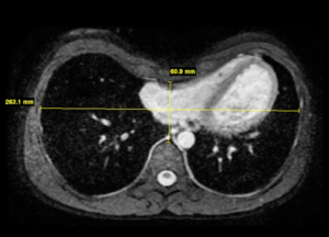 Pectus Excavatum pectus-excavatum