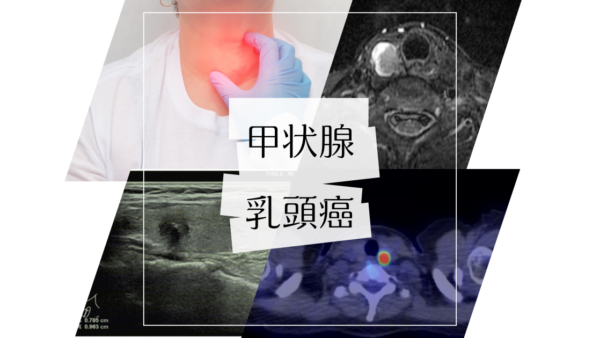 甲状腺乳頭癌（PTC. Papillary thyroid carcinoma） – 内分泌疾患