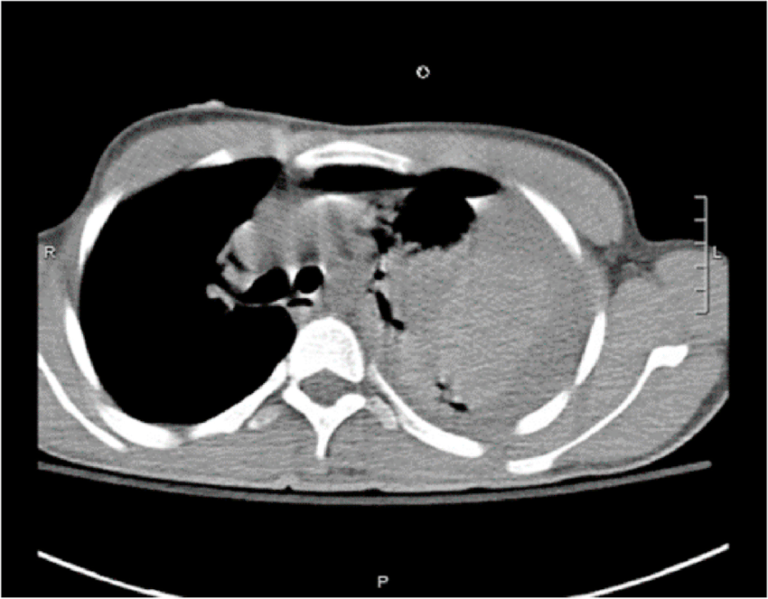 血気胸(Hemopneumothorax) – 呼吸器疾患 - 神戸きしだクリニック(神戸市中央区)