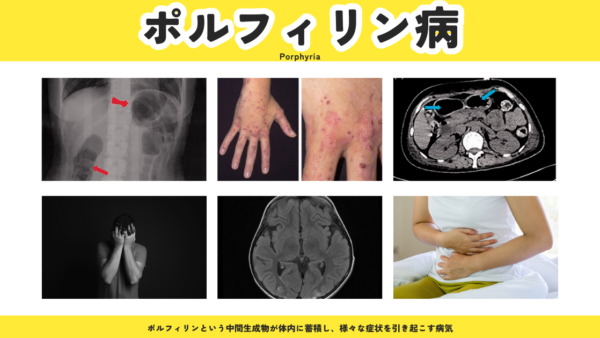 ポルフィリン症（Porphyria） – 代謝疾患