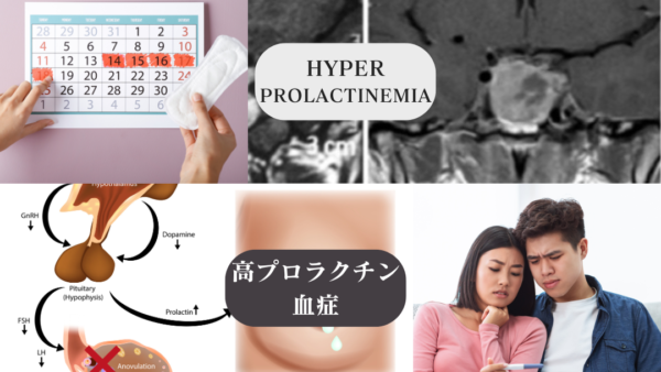 高プロラクチン血症（Hyperprolactinemia） – 内分泌疾患