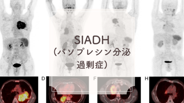 SIADH（バソプレシン分泌過剰症）（SIADH. Syndrome of inappropriate secretion of Antidiuretic Hormone） – 内分泌疾患