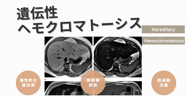 遺伝性ヘモクロマトーシス（HH. Hereditary Hemochromatosis） – 代謝疾患