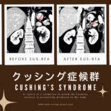 クッシング症候群（CS. Cushing’s syndrome） – 内分泌疾患