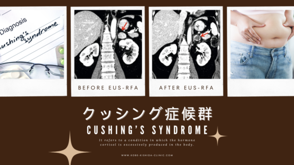 クッシング症候群（CS. Cushing’s syndrome） – 内分泌疾患