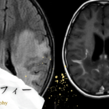 副腎白質ジストロフィー（ALD：Adrenoleukodystrophy） – 代謝疾患