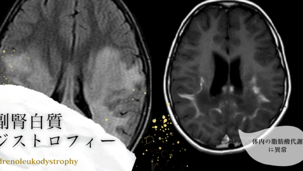 副腎白質ジストロフィー（ALD：Adrenoleukodystrophy） – 代謝疾患