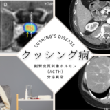 クッシング病（Cushing’s disease） – 内分泌疾患