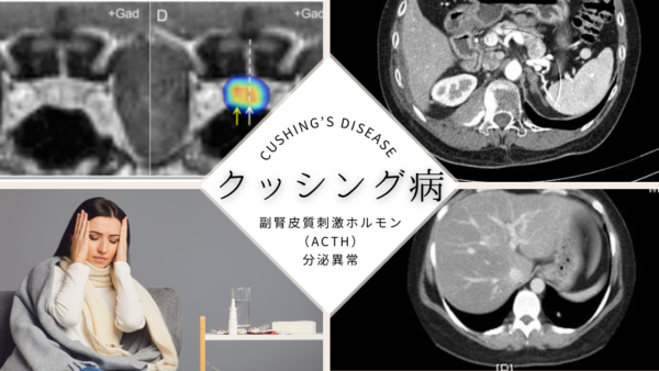 クッシング病（Cushing’s disease） – 内分泌疾患