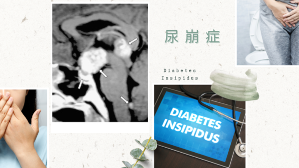 尿崩症（DI. Diabetes Insipidus） – 内分泌疾患