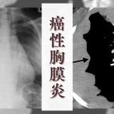癌性胸膜炎（Pleural carcinomatosis / Carcinomatous pleurisy） – 呼吸器疾患