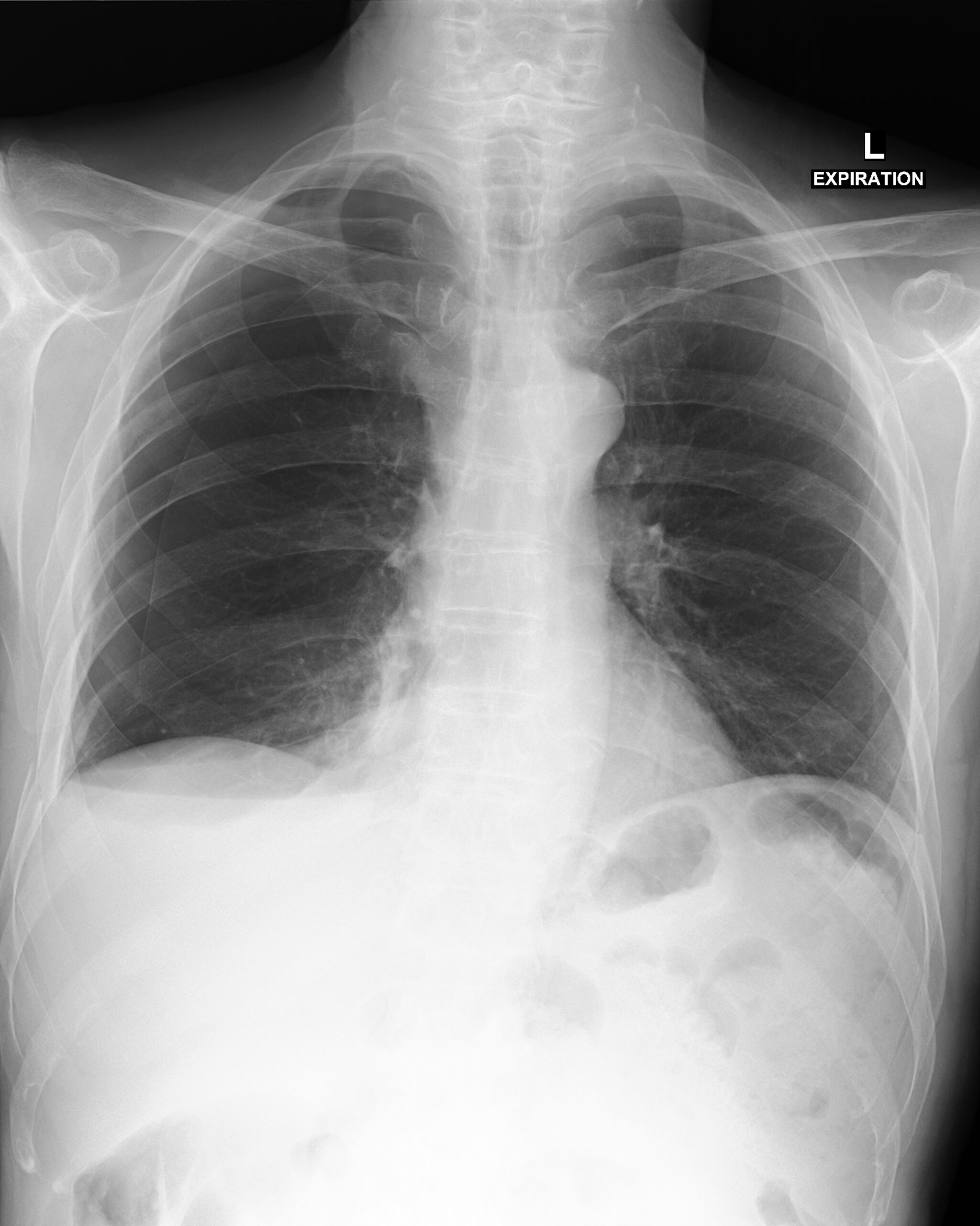 血気胸(Hemopneumothorax) – 呼吸器疾患 - 神戸きしだクリニック(神戸市中央区)
