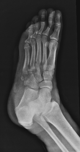 画像に alt 属性が指定されていません。ファイル名: diabetic-foot-and-secondary-osteomyelitis.png