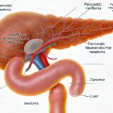 膵神経内分泌腫瘍（PanNEN）（Pancreatic neuroendocrine neoplasm） – 内分泌疾患