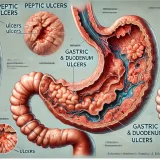 消化性潰瘍（胃潰瘍・十二指腸潰瘍）