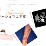 リーシュマニア症 （Leishmaniasis） – 感染症