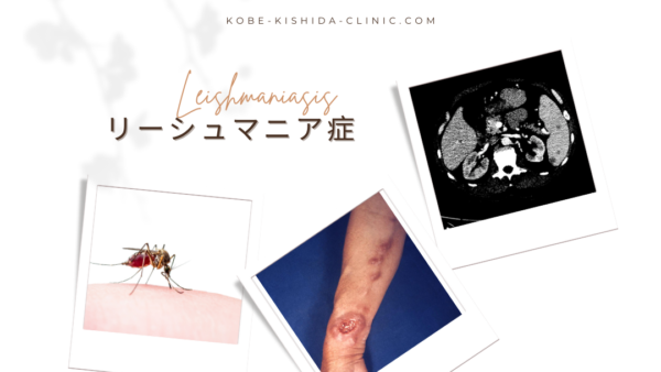 リーシュマニア症 （Leishmaniasis） – 感染症