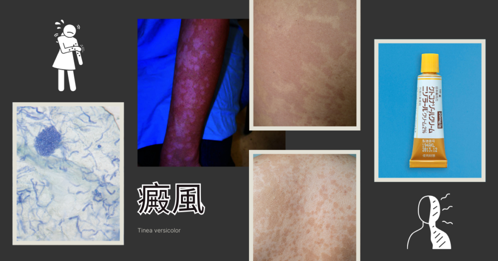 癜風(Tinea versicolor) – 感染症 - 神戸きしだクリニック(神戸市中央区)