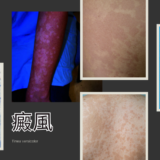 癜風（Tinea versicolor） – 感染症