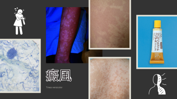 癜風（Tinea versicolor） – 感染症