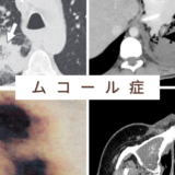 ムーコル症 / ムコール症（接合菌症）（Mucormycosis） – 感染症