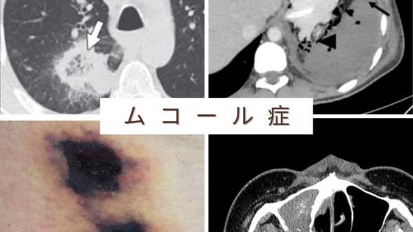 ムーコル症 / ムコール症（接合菌症）（Mucormycosis） – 感染症