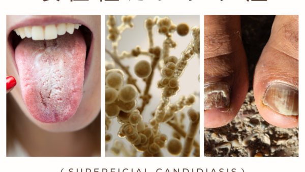 表在性カンジダ症（Superficial candidiasis） – 感染症