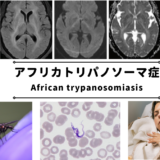 アフリカトリパノソーマ症（アフリカ睡眠病）（African trypanosomiasis） – 感染症