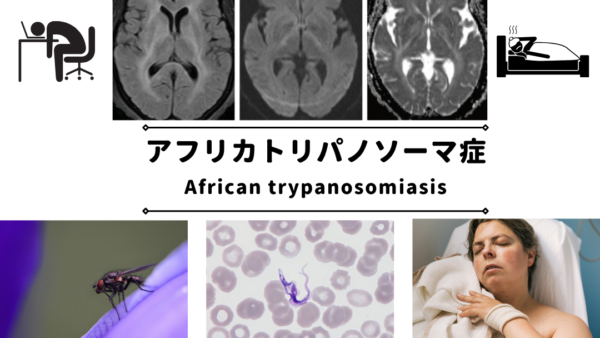 アフリカトリパノソーマ症（アフリカ睡眠病）（African trypanosomiasis） – 感染症