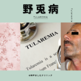 野兎病（Tularemia） – 感染症