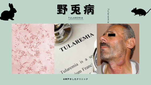 野兎病（Tularemia） – 感染症