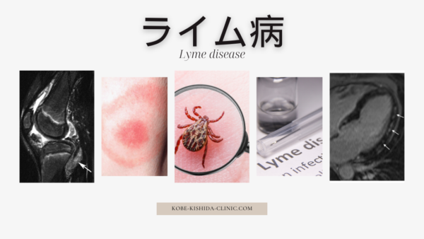 ライム病（Lyme disease） – 感染症