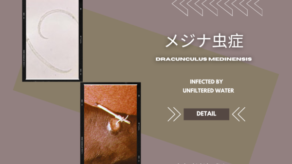 メジナ虫症（Dracunculus / Guinea worm disease） – 感染症