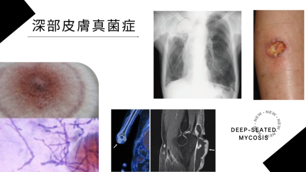 深部皮膚真菌症（Deep Cutaneous Mycoses） – 感染症