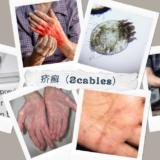 疥癬（Scabies） – 感染症