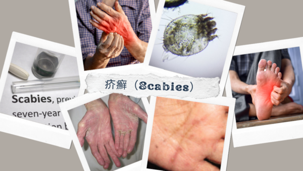 疥癬（Scabies） – 感染症