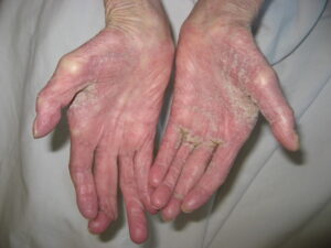 疥癬(Scabies) – 感染症 - 神戸きしだクリニック(神戸市中央区)